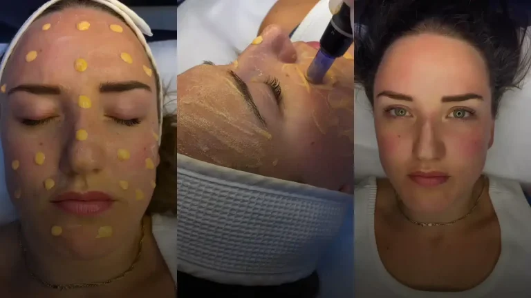 Discover Realistic Solutions for Scar Concealment in Dubai