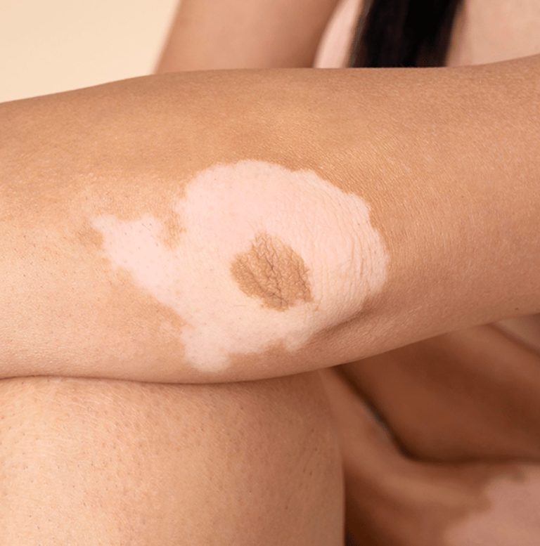 Permanent scar concealment in Dubai: practical guide
