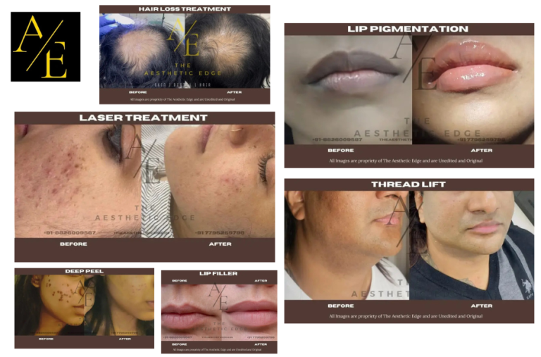 Effective MNRF Treatment in Bengaluru for Advanced Skin Rejuvenation and Tightening