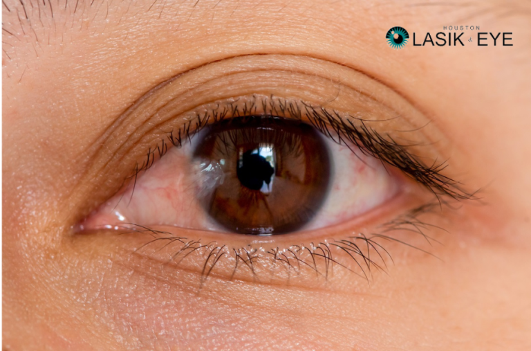 Pterygium Surgery Recovery Guide – Tips for a Smooth Healing Process