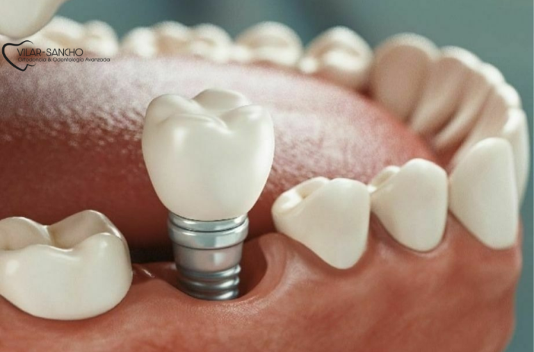 Prevención Dental en Pozuelo de Alarcón: Cuida tu Sonrisa con Expertos Locales
